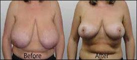 Breast Reduction Surgery in Udaipur, Rajasthan