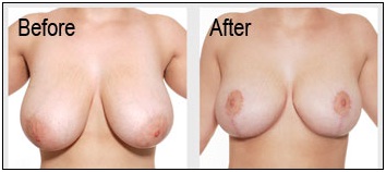 Breast Reduction Surgery in Udaipur