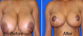 Breast Reduction Surgery in Udaipur, India