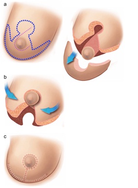 Best Breast Reduction Specialist in Udaipur, Rajasthan