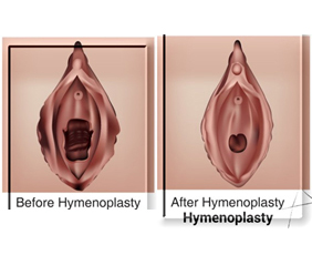 Hymenoplasty Rajasthan